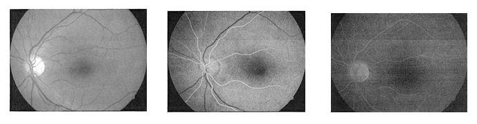 Angiografia fluoresceinowa