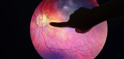 Czym jest dziecięca retinopatia wcześniacza?