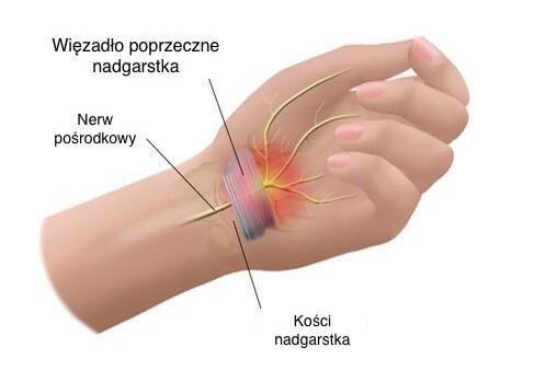 zespol ciesni nadgarstka