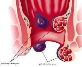 Zabiegi proktologiczne