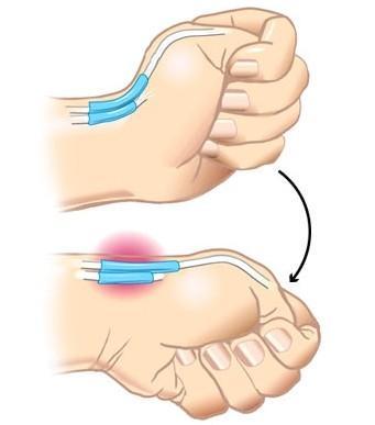 Zespół de Quervaina